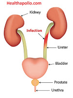 UTI ( Urinary tract infection) Causes , Symptoms and Home remedies