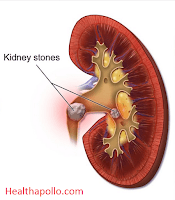 home based remedies for Kidney Stone for fast result