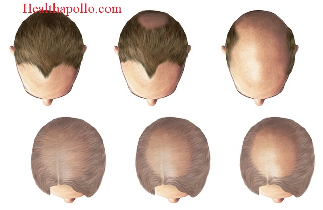Hair loss patterns in men apollo